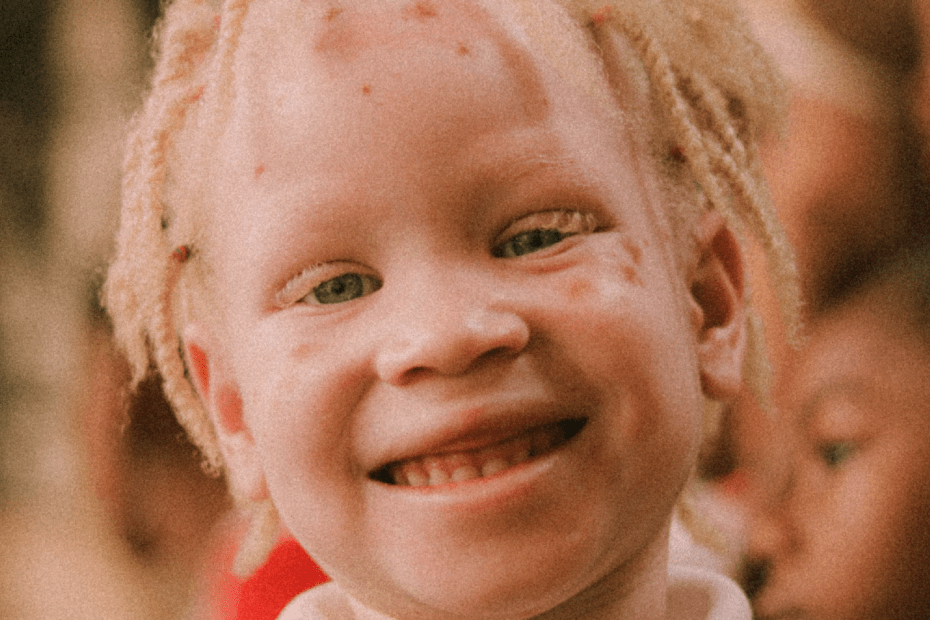 Niño con albinismo mira de frente a la cámara y sonríe.